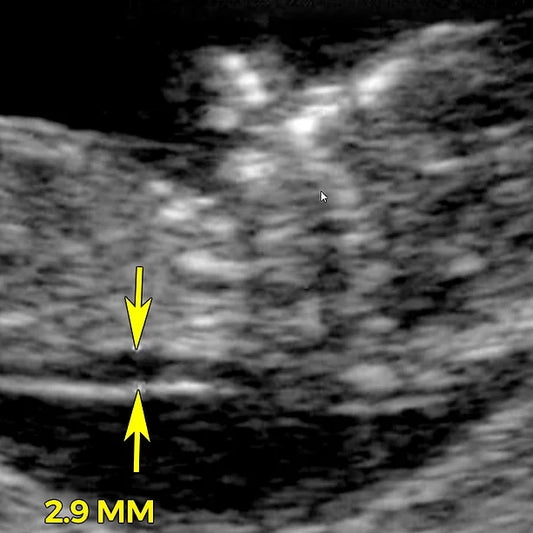 Nuchal translucency (NT) scan